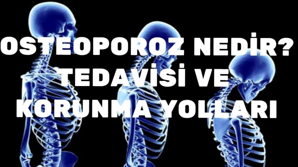 Osteoporoz Belirtileri, Önlenmesi ve Tedavisi